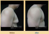 Breast Reduction Surgery for Men Patient