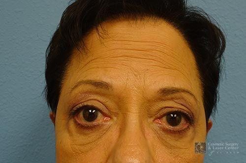 photo_gallery_before1491case_1.jpg