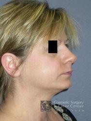 photo_gallery_before371case_2.jpg