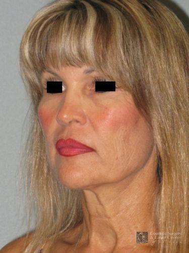 photo_gallery_before863case_4.jpg