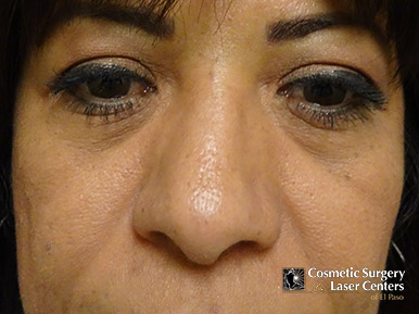 blepharoplasty_53_before-front
