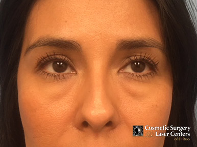 blepharoplasty_54_before-front