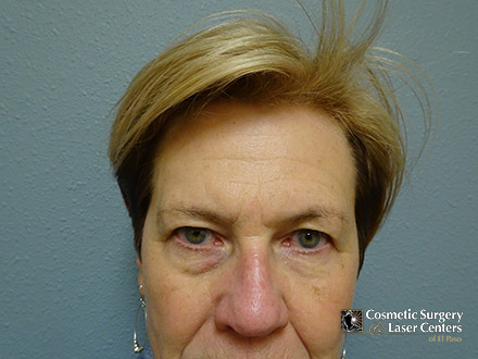 brow-lift_9_before-front