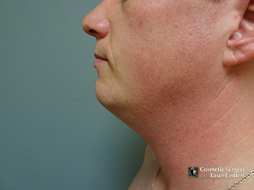 liposuction_19_chin_before-side-r