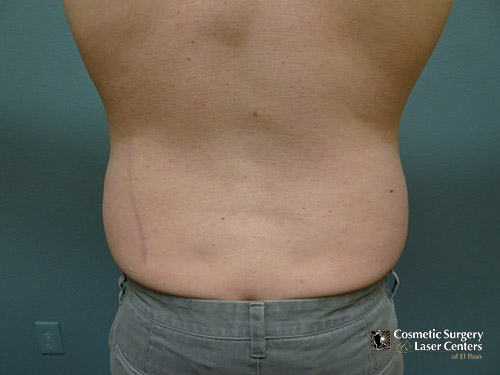 liposuction_19_trunk_before-back