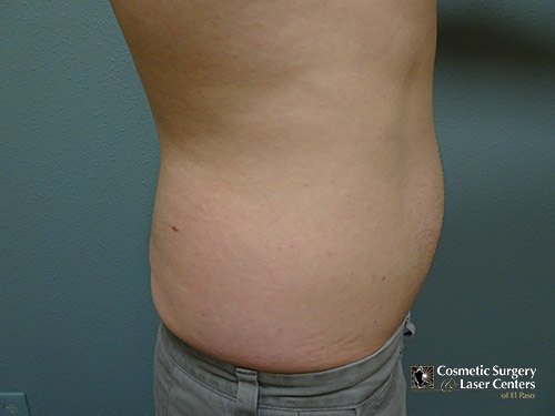 liposuction_19_trunk_before-side-l