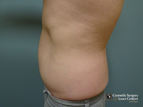 liposuction_19_trunk_before-side-r