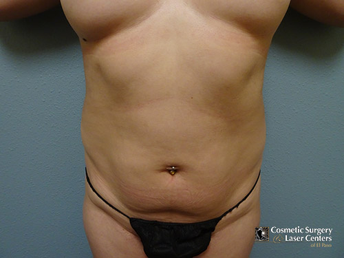 liposuction_20_before-front