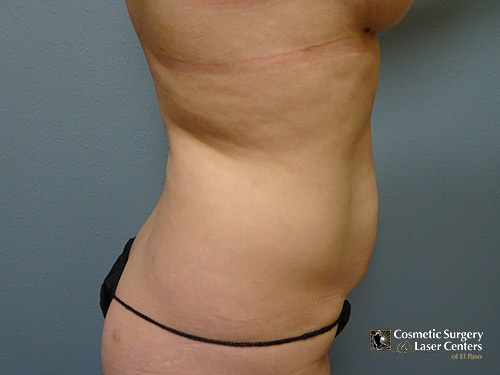liposuction_20_before-side-l