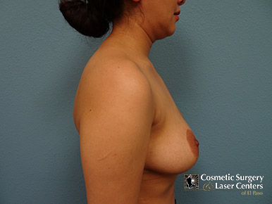 mastopexy_78_before-side-l