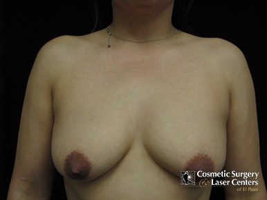 mastopexy_79_before-front