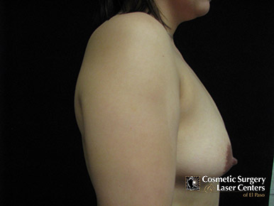 mastopexy_79_before-side-l