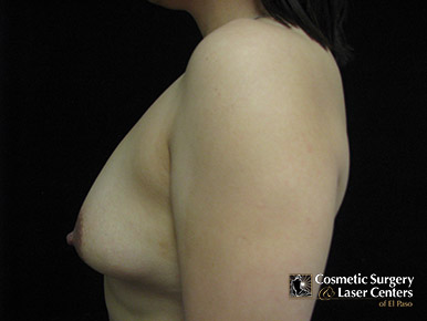 mastopexy_79_before-side-r