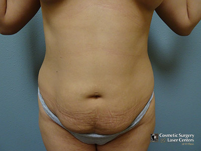tummy-tuck_123_before-front
