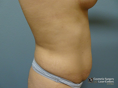 tummy-tuck_123_before-side-l