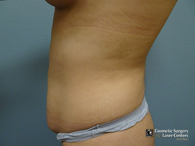 tummy-tuck_123_before-side-r