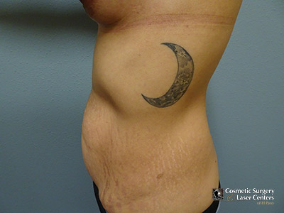 tummy-tuck_124_before-side-r