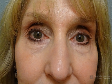 blepharoplasty