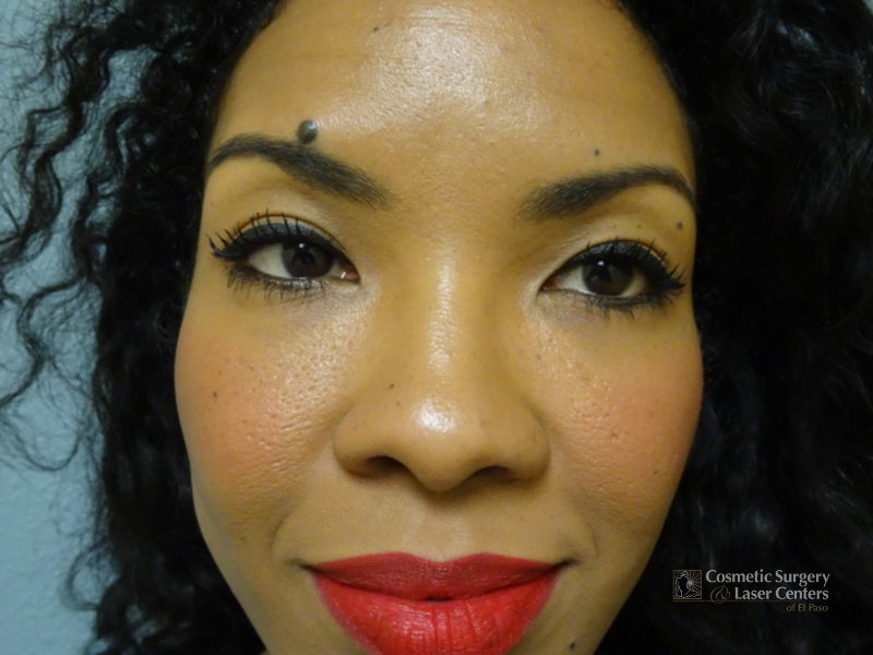before-front-rhinoplasty