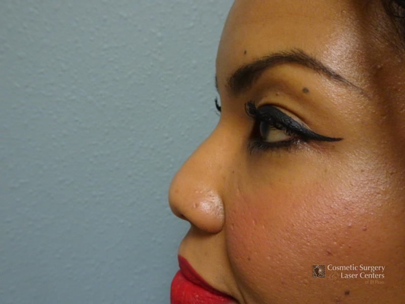 before-left-rhinoplasty