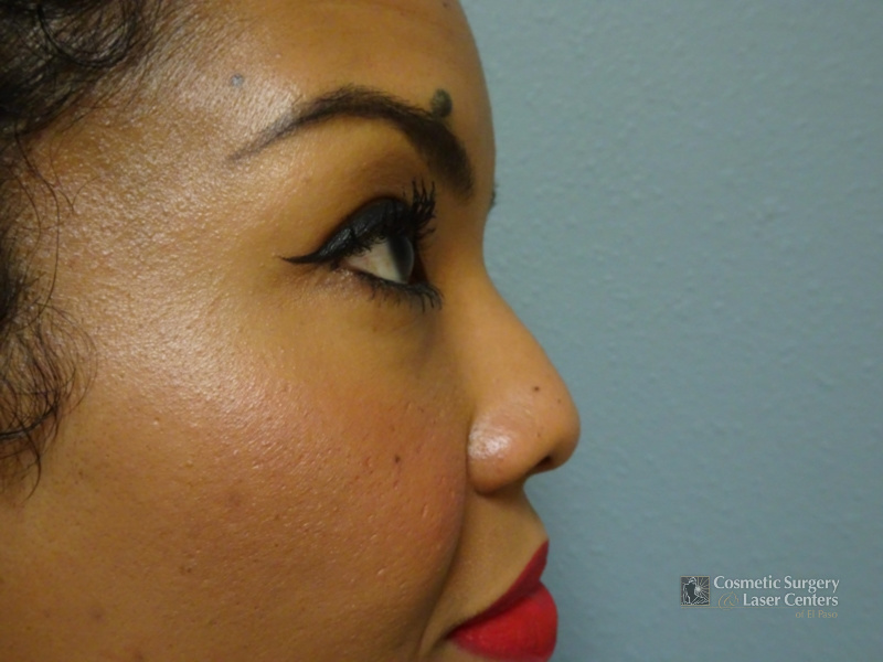 before-right-rhinoplasty