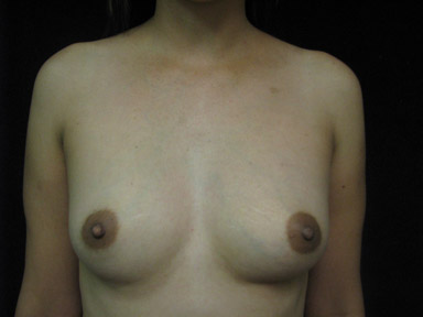 breast-aug_233_before-front