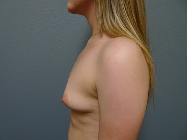 breast-aug_234_before-side-r