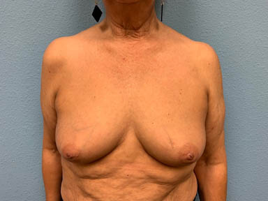 breast-aug_237_6