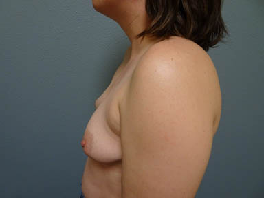 breast-aug_239_5