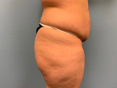 butt-lift_17_6