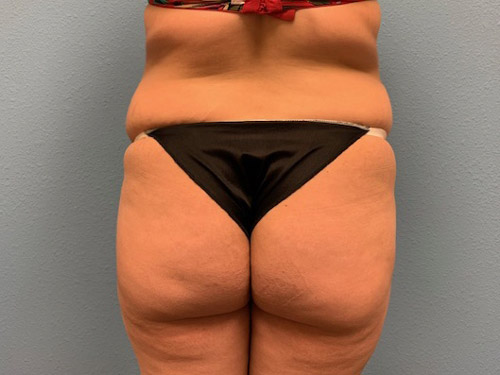 butt-lift_17_8