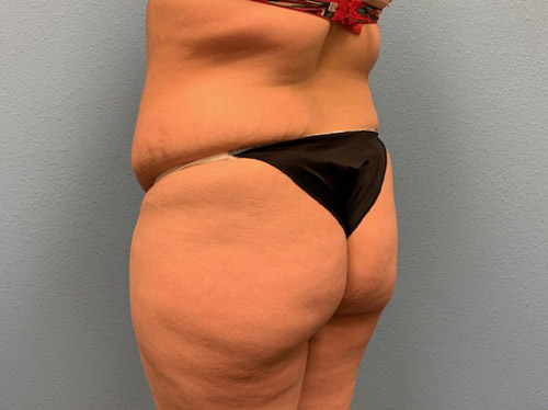 butt-lift_17_9