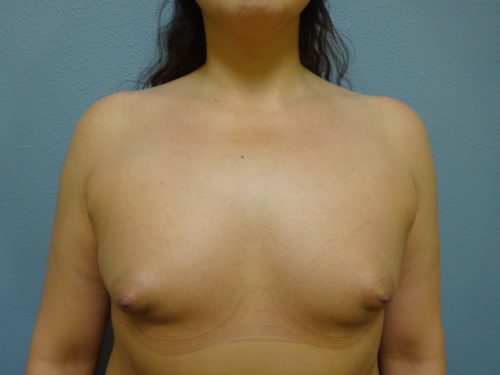 breast_aug_240_1