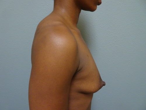 breast_aug_242_4