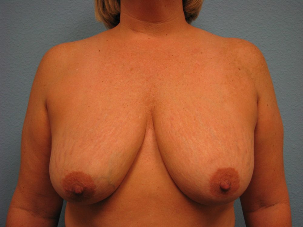 breast_lift_patient-82-before-front