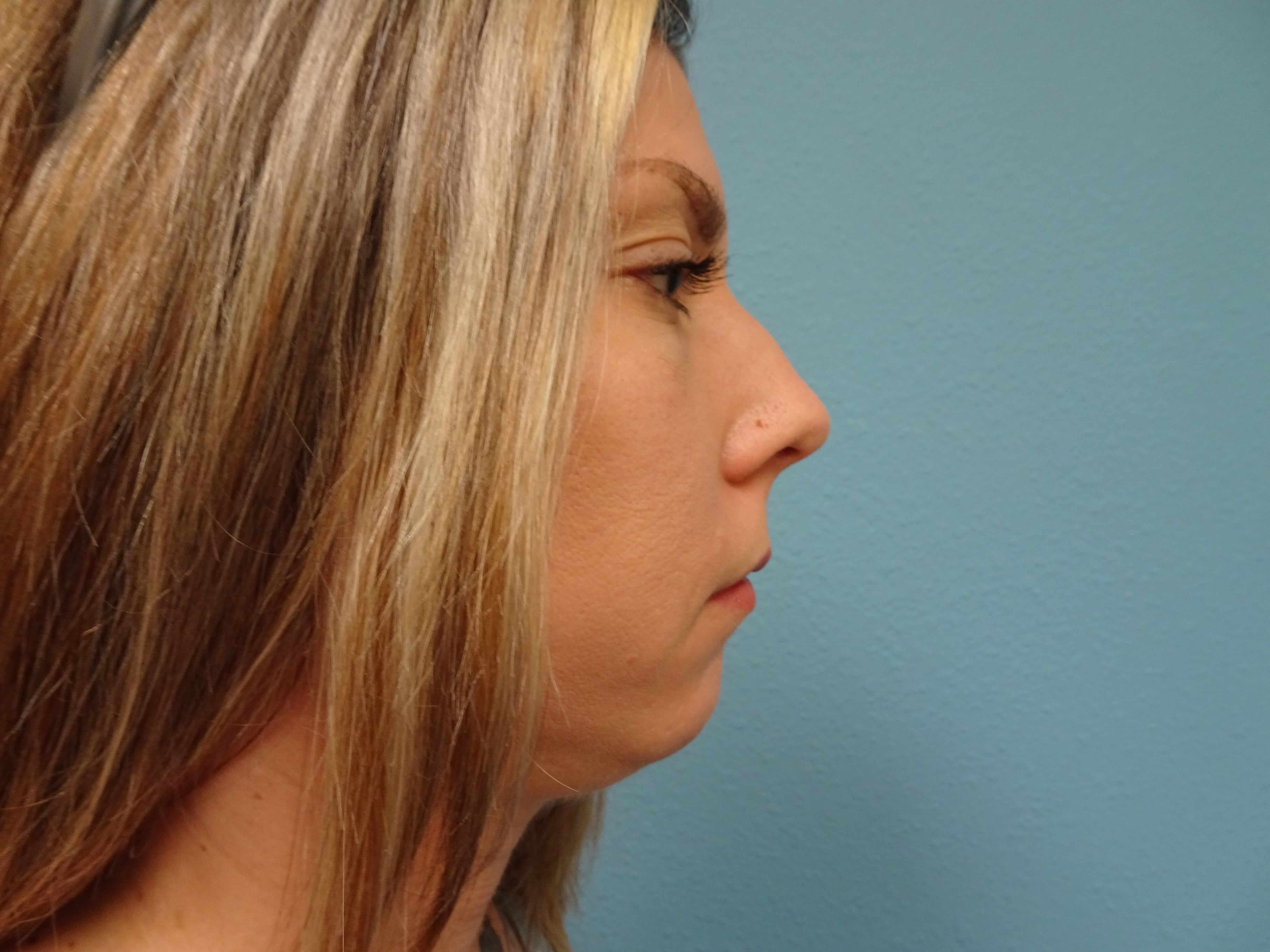 chin_augmentation patient 7 before right