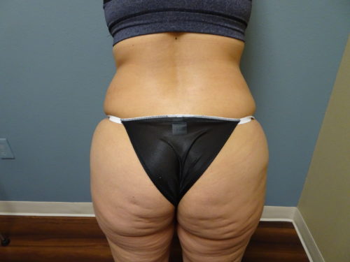 tummy-tuck_129-4