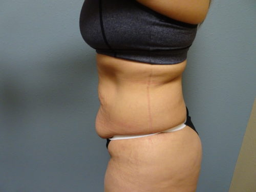 tummy-tuck_129_8