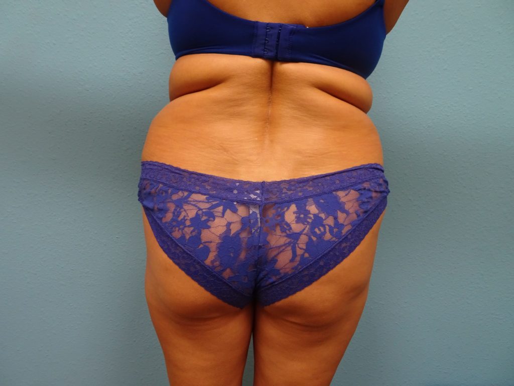 bbl-patient-18-before-back