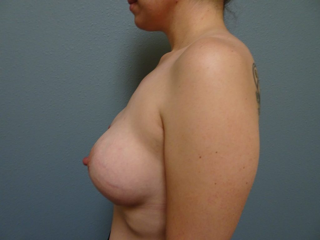 patient-243-breast-aug-left-before