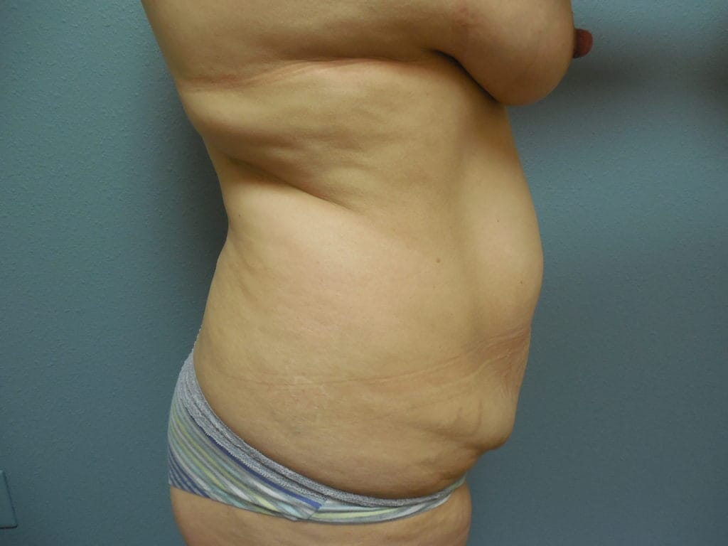 patient-130-tummy-tuck-r-before