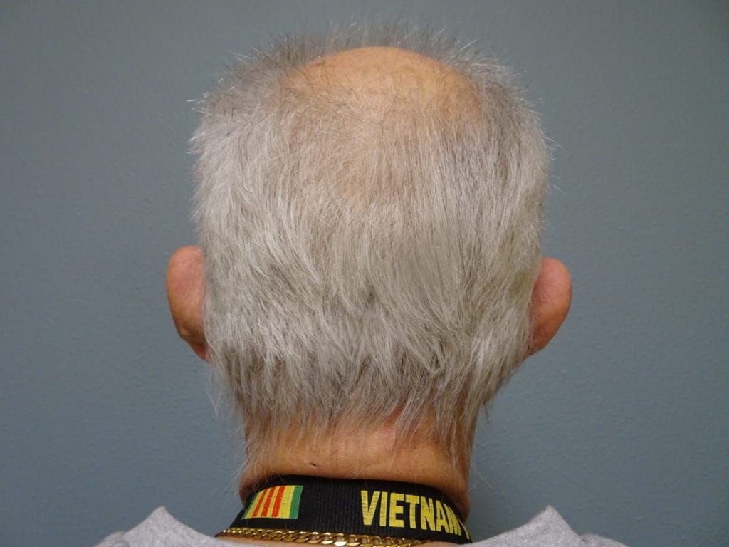 patient-16-back-before