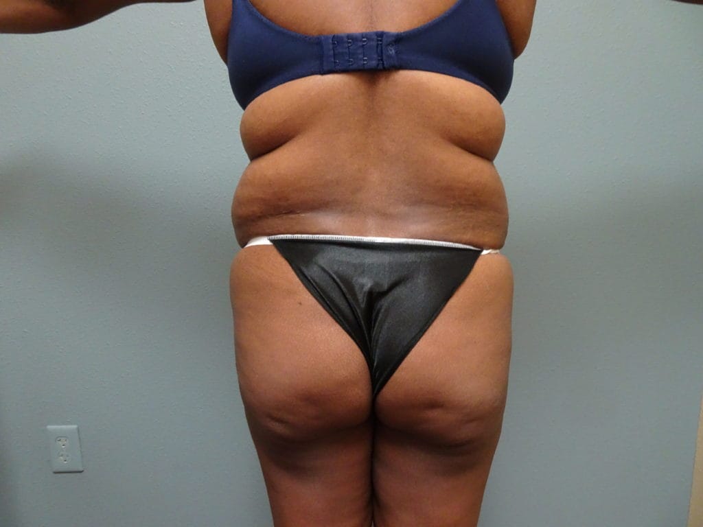 patient-21-bbl-lipo-back-before