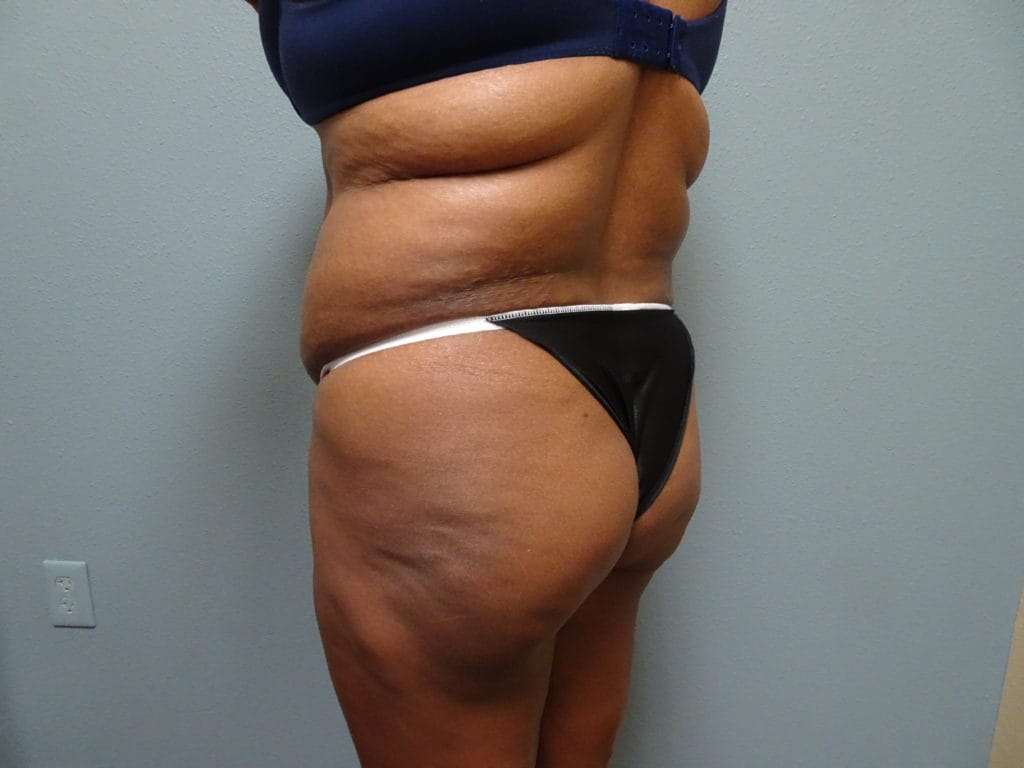 patient-21-bbl-lipo-l-oblique-before