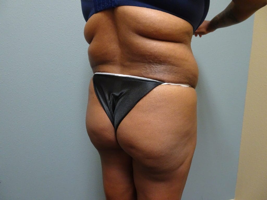 patient-21-bbl-lipo-r-oblique-before