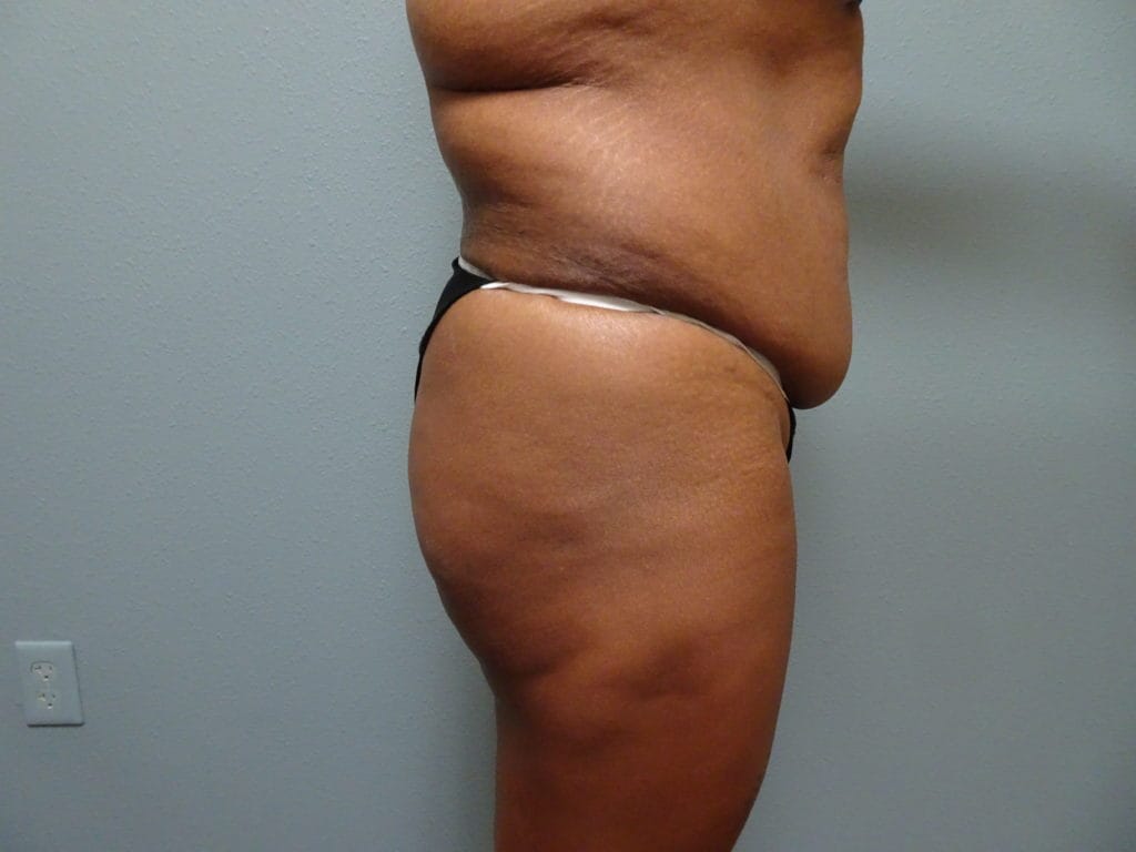 patient-21-bbl-lipo-r-side-before