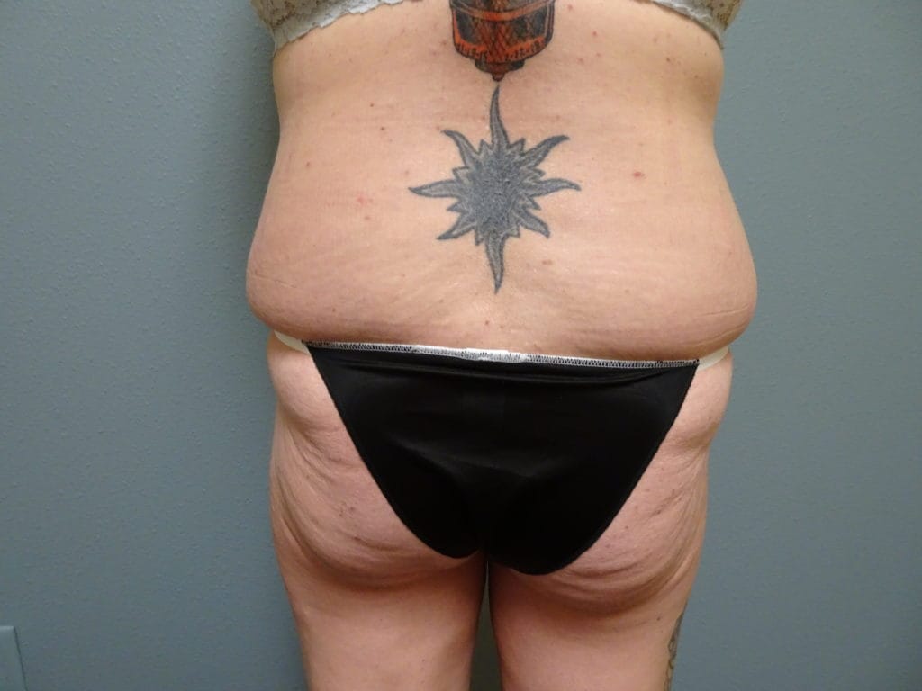 patient-25-bbl-back-before