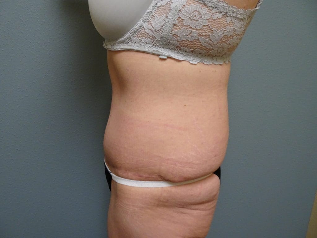 patient-25-bbl-l-side-before