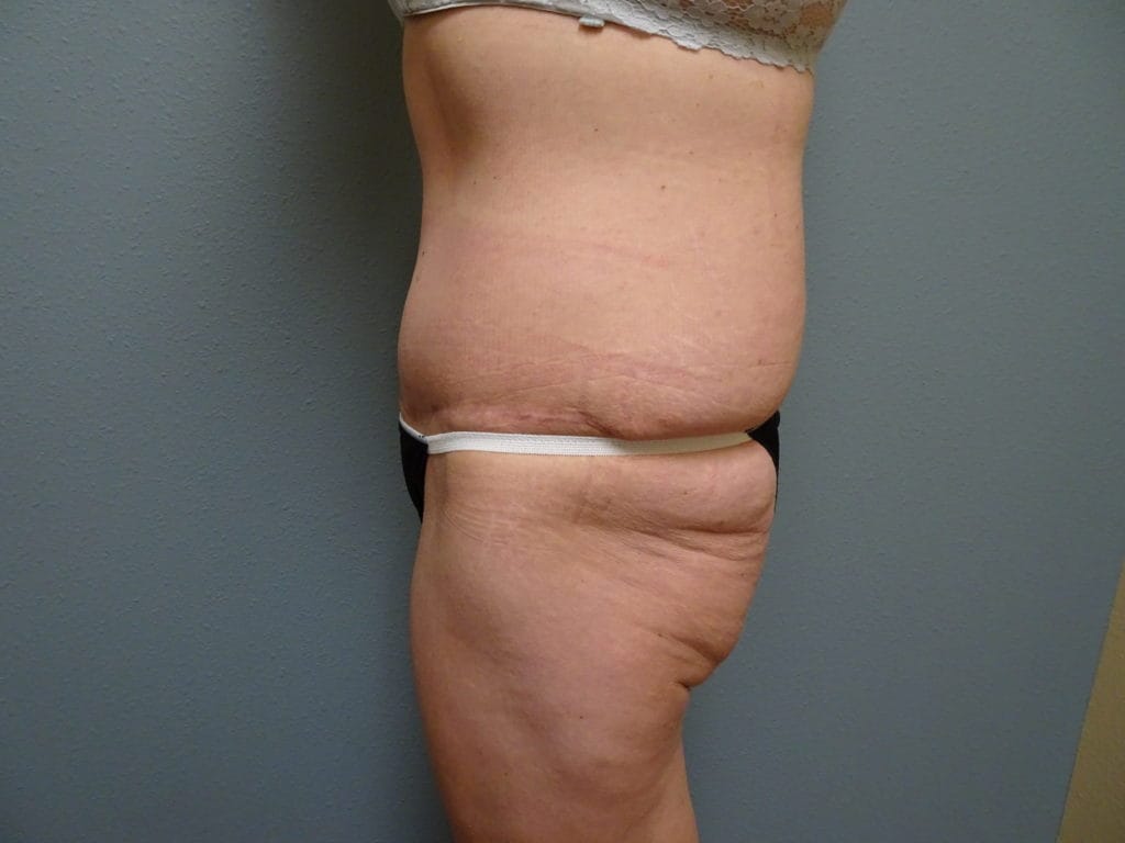 patient-25-bbl-left-side-before