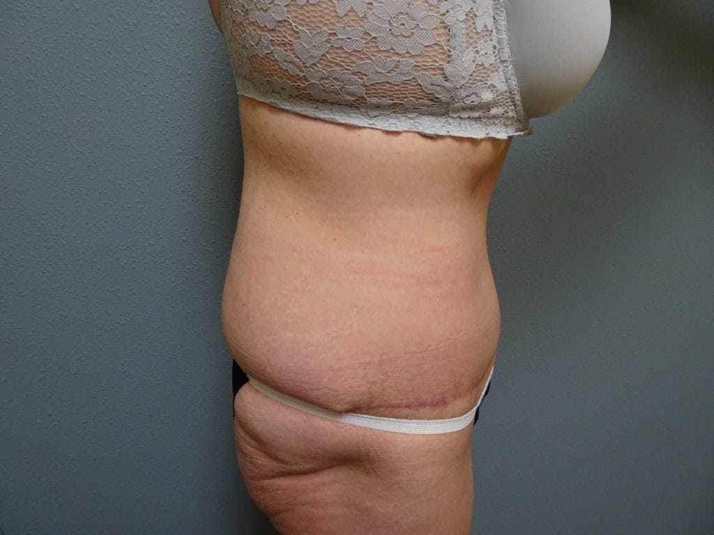 patient-25-bbl-r-side-before